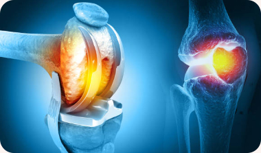 Knee Replacement  Surgery