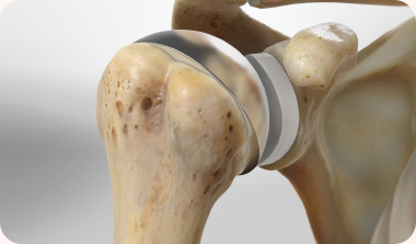 Shoulder Replacement Surgery