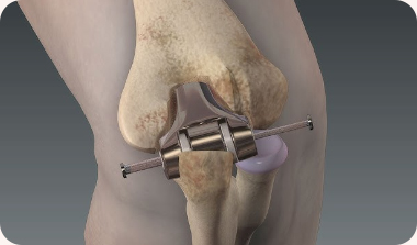 Elbow Replacement  Surgery