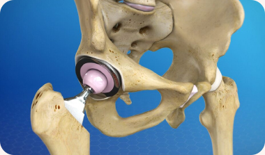 Hip Replacement Surgery