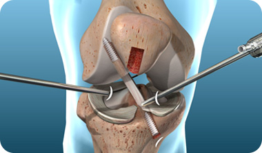 Ligament Reconstruction